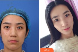 中國(guó)人民解放軍第100醫(yī)院整形美容中心李欣整形價(jià)格表附埋線提升案例展示