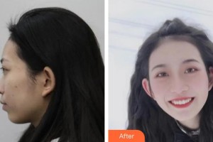 中國(guó)人民解放軍455胎記診療中心孫曉迪整形價(jià)格表附埋線提升案例展示