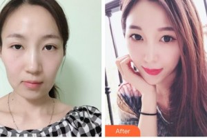 中國(guó)人民解放軍第100醫(yī)院整形美容中心陳舒整形價(jià)格表附熱瑪吉案例展示