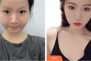 中國(guó)人民解放軍第100醫(yī)院整形美容中心汪松林整形價(jià)格表附埋線提升案例展示