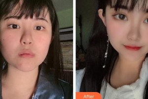 第四軍醫(yī)大學(xué)唐都醫(yī)院整形激光美容中心陳紹宗整形價格表附鼻翼縮小案例展示