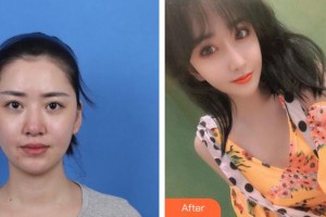 第四軍醫(yī)大學(xué)唐都醫(yī)院整形激光美容中心李躍軍整形價格表附鼻部綜合案例展示