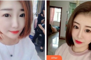 第四軍醫(yī)大學(xué)唐都醫(yī)院整形激光美容中心李學(xué)擁整形價格表附肋軟骨隆鼻案例展示