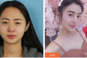 第四軍醫(yī)大學(xué)唐都醫(yī)院整形激光美容中心杜潔整形價格表附鼻部綜合案例展示