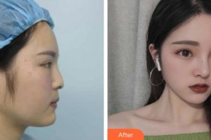 第四軍醫(yī)大學(xué)唐都醫(yī)院整形激光美容中心李靖整形價格表附鼻部綜合案例展示