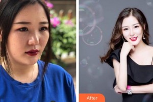 第四軍醫(yī)大學(xué)唐都醫(yī)院整形激光美容中心曹彥整形價格表附耳軟骨復(fù)合隆鼻案例展示