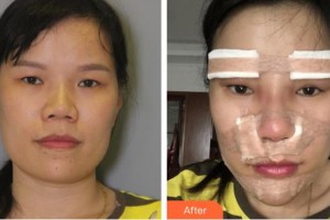 第四軍醫(yī)大學(xué)唐都醫(yī)院整形激光美容中心劉綱整形價格表附鼻部綜合案例展示