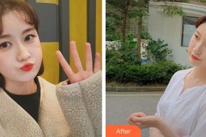 第四軍醫(yī)大學(xué)唐都醫(yī)院整形激光美容中心呂小星整形價格表附墊鼻基底案例展示