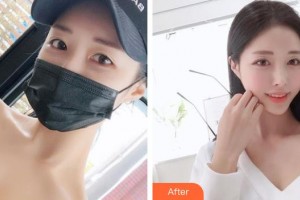 中國醫(yī)學(xué)科學(xué)院整形外科醫(yī)院趙振民整形價格表附光子嫩膚案例展示