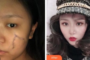 中國醫(yī)學(xué)科學(xué)院整形外科醫(yī)院滕利整形價格表附激光祛疤案例展示