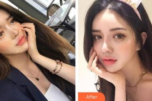 中國醫(yī)學(xué)科學(xué)院整形外科醫(yī)院馬繼光整形價格表附祛斑祛痣案例展示