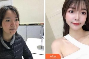 中國醫(yī)學(xué)科學(xué)院整形外科醫(yī)院劉珍君整形價格表附光子嫩膚案例展示