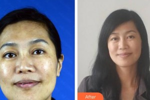 中國醫(yī)學(xué)科學(xué)院整形外科醫(yī)院楊斌整形價格表附光子嫩膚案例展示