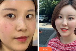 中國醫(yī)學(xué)科學(xué)院整形外科醫(yī)院孫曉梅整形價格表附彩光嫩膚案例展示