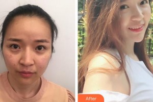 中國醫(yī)學(xué)科學(xué)院整形外科醫(yī)院趙延勇整形價格表附去痘印痘坑案例展示