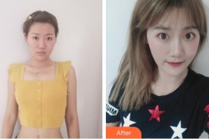 中國醫(yī)學(xué)科學(xué)院整形外科醫(yī)院宋維銘整形價格表附激光祛疤案例展示