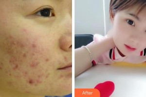 中國醫(yī)學(xué)科學(xué)院整形外科醫(yī)院劉立強、副教授整形價格表附去痘印痘坑案例展示