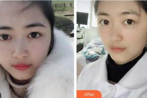 中國醫(yī)學(xué)科學(xué)院整形外科醫(yī)院何樂人整形價格表附祛斑祛痣案例展示