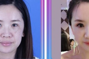 中國醫(yī)學(xué)科學(xué)院整形外科醫(yī)院穆大力整形價格表附激光祛斑案例展示