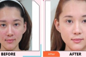 中國醫(yī)科大學(xué)航空總醫(yī)院皮膚激光整形美容中心孫志成整形價格表附鐳射凈膚案例展示