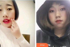 中國航天科工集團731醫(yī)院整形美容科陳志剛整形價格表附根管調(diào)節(jié)案例展示