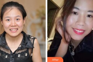 中國醫(yī)科大學(xué)航空總醫(yī)院拇外翻矯正科宋春蘭整形價格表附自鎖托槽矯正案例展示