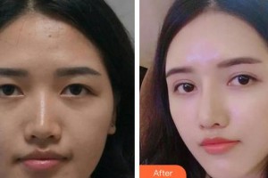 中國科大眼科醫(yī)院陳鶯整形價格表附開內(nèi)眼角案例展示