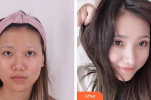 中國醫(yī)科大學(xué)附屬第一醫(yī)院整形外科金石峰整形價格表附切開雙眼皮案例展示