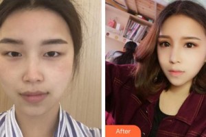 中國醫(yī)科大學(xué)附屬第一醫(yī)院整形外科徐楠整形價格表附眼部綜合案例展示