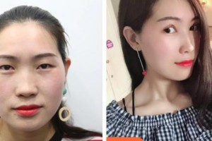 中國醫(yī)科大學(xué)附屬第一醫(yī)院整形外科孫強整形價格表附眼部綜合案例展示