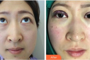 中國醫(yī)科大學(xué)附屬第一醫(yī)院整形外科冷冰整形價格表附眼部綜合案例展示