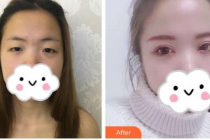 中國醫(yī)科大學(xué)附屬第一醫(yī)院整形外科唐明睿整形價格表附眼部綜合案例展示