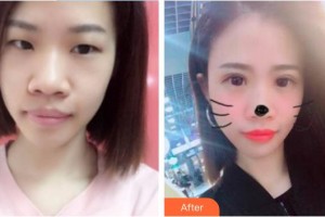 中國醫(yī)科大學(xué)附屬第一醫(yī)院整形外科王玉新整形價格表附切開雙眼皮案例展示