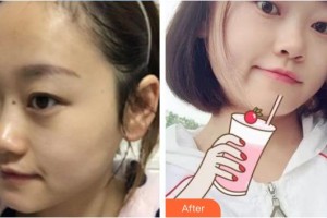 福清天寶美容醫(yī)院孟祥重整形價格表附膨體隆鼻案例展示