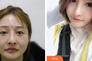 福清天寶美容醫(yī)院林芳整形價格表附鼻部綜合案例展示