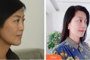 福清天寶美容醫(yī)院葉存祥整形價格表附鼻部綜合案例展示