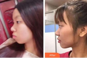 福清天寶美容醫(yī)院舒小芳整形價格表附金屬托槽矯正案例展示