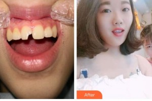 象山華美整形美容醫(yī)院馮智勇整形價格表附美白貼片案例展示