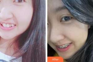 象山華美整形美容醫(yī)院洪燕整形價格表附金屬托槽矯正案例展示