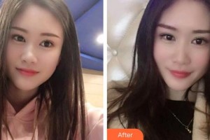 象山華美整形美容醫(yī)院許哲整形價格表附冷光美白案例展示