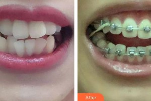 象山華美整形美容醫(yī)院沉載善整形價格表附金屬托槽矯正案例展示