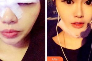 象山愛爾眼科醫(yī)院趙景峰整形價格表附切開雙眼皮案例展示