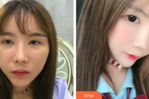 象山愛爾眼科醫(yī)院張美萍整形價格表附下瞼整形案例展示