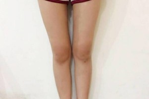 昆明醫(yī)學(xué)院整形美容中心如何？附吸脂瘦腿附果圖及價(jià)格一覽