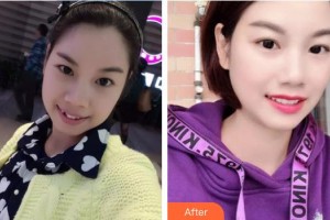 象山華美整形美容醫(yī)院郝慶忠整形價格表附金屬托槽矯正案例展示