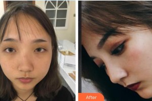 郴州維納斯醫(yī)療美容醫(yī)院劉文閣整形價(jià)格表附硅膠隆鼻案例展示