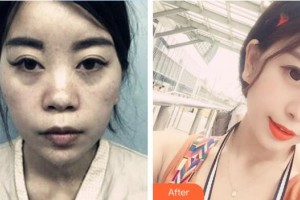 郴州市第一人民醫(yī)院整形美容科唐紅偉整形價格表附鼻部綜合案例展示