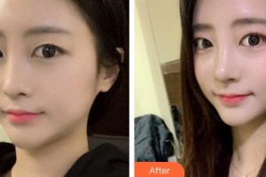 郴州韓雅醫(yī)療美容醫(yī)院明經(jīng)發(fā)整形價格表附鼻部綜合案例展示