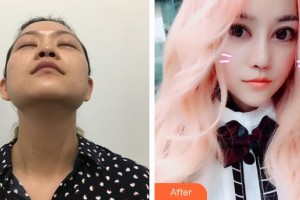 郴州韓雅醫(yī)療美容醫(yī)院楊嬌整形價格表附鼻部綜合案例展示