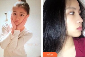 郴州市明華醫(yī)院醫(yī)學美容科竇學禮 整形價格表附鼻部綜合案例展示